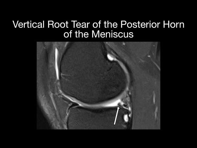 Vertical Root Tear of Posterior Horn of the Meniscus and Meniscal Ossicle