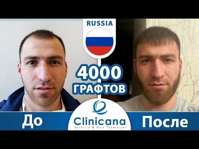 Шамхал  из России и его операция по пересадке волос в Clinicana