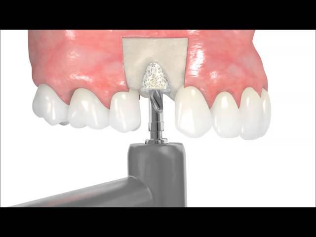 the botiss maxgraft bonering technique by Dr. Bernd Giesenhagen