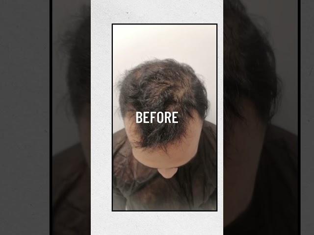 Amazing Hair Transplant!