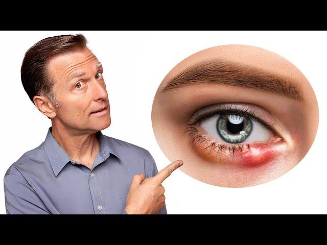 What Really Causes Styes and How to Get Rid of Them Fast