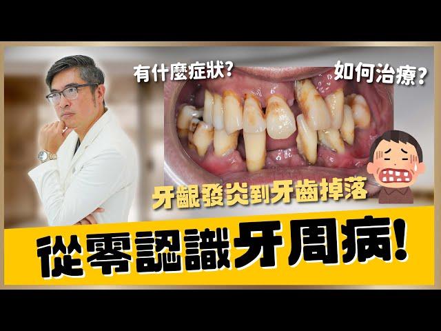 牙周病完整大解析，從零認識牙周病！牙齦發炎、腫痛、牙縫變大到牙齒掉落，從4大階段自我檢視牙周病的程度與治療方法｜【祐民牙醫－隱適美旗艦店】鑽石級楊大為醫師 #牙周病 #刷牙 #洗牙 #水雷射 #拔牙