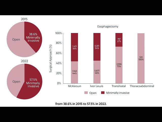 Risk Calculator for Esophagectomy