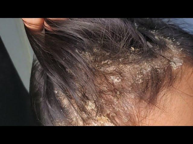 Dandruff Removal - Scalp Scratching