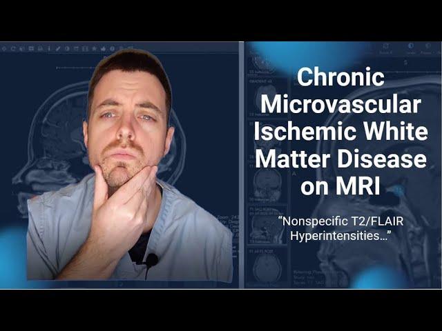 Chronic Microvascular Ischemic White Matter Disease of the Brain on MRI