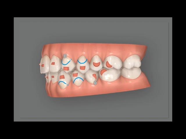 Invisalign clincheck. Treatment simulation to corect an open bite for adult patient