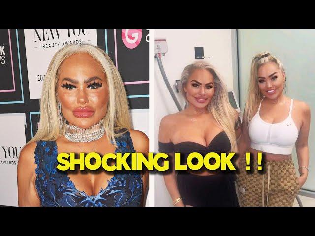 Darcey Silva Shocks Fans With Botched Face Following New Plastic Surgery