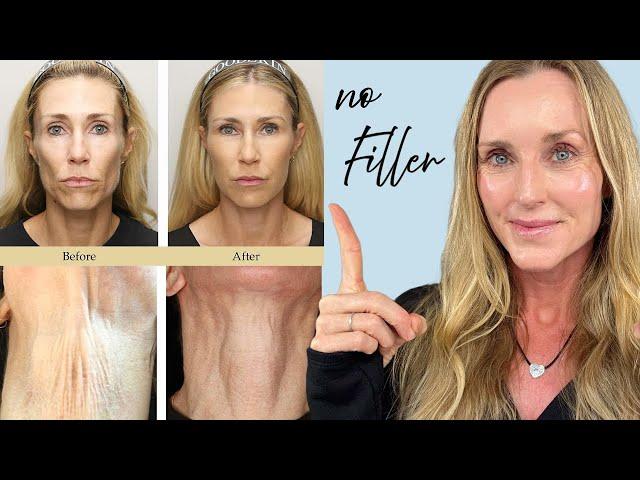 NATURALLY & PERMANENTLY Restore Facial Fat/Volume WITHOUT FILLER