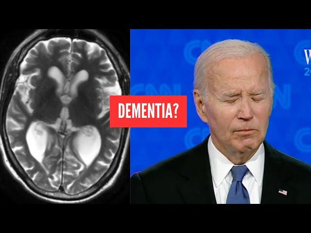 Doctor Opinion: What a doctor sees when Joe Biden hesitates - Dementia?