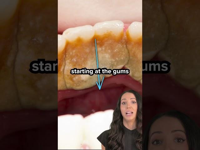 plaque vs tartar on teeth (dental calculus) #shorts