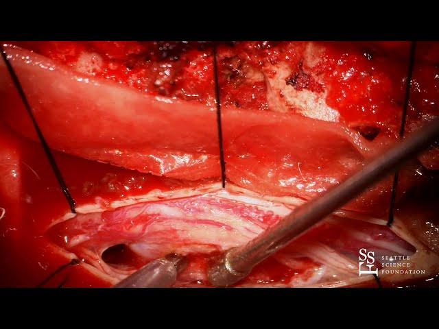 Live Surgery: Resection of Spinal Tumor - Rod J. Oskouian, M.D.