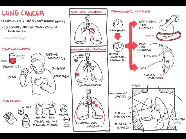 Lung Cancer - Overview