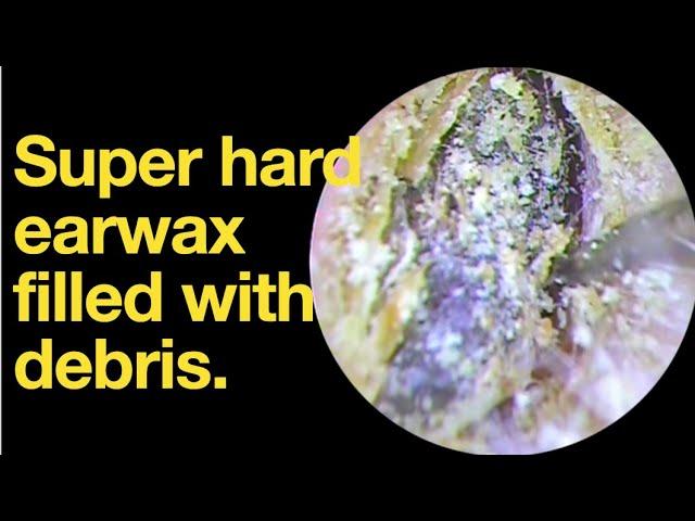 Super hard earwax filled with debris. |ear wax removal | ear cleaning | ASMR | relaxation | relax