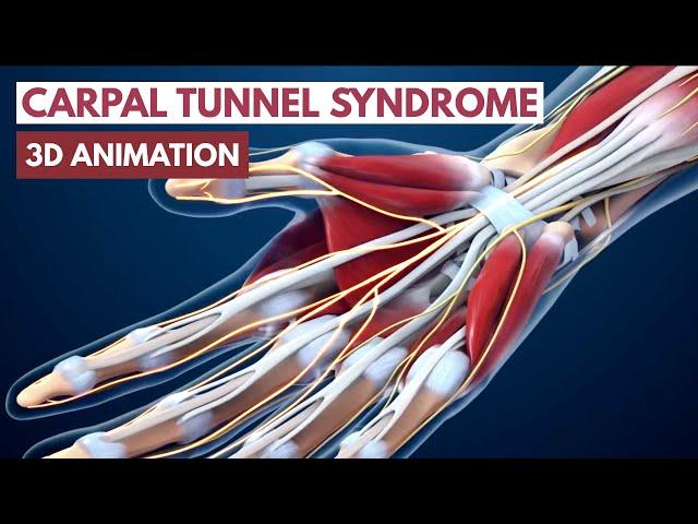 Carpal Tunnel Syndrome l 3D Animation