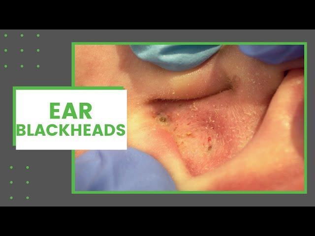 Ear Blackheads | Dr. Derm