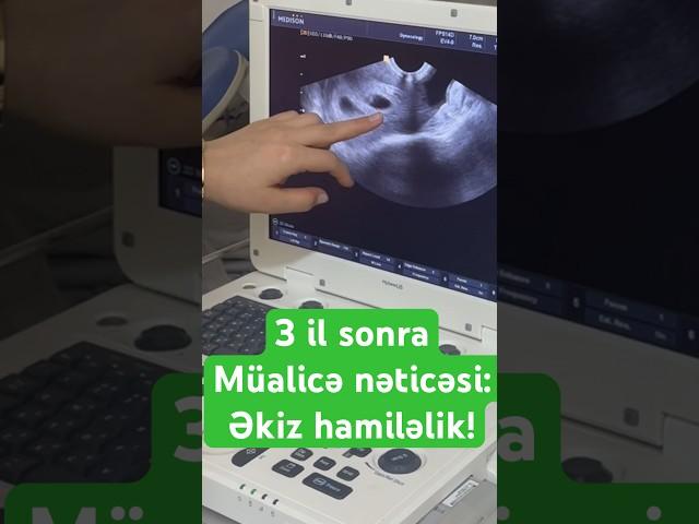 3 il sonra əkiz hamiləlik. İlk kurs müalicə ilə 050 989 82 52#shorts #twins #pcos #