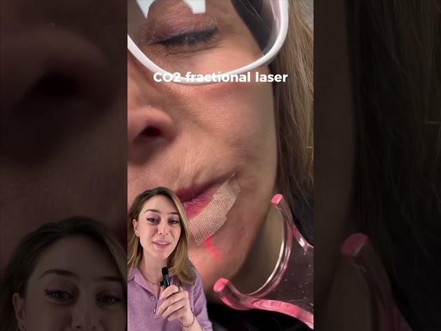 Co2 Laser for Wrinkles Around Your Mouth #co2laser #wrinkles #dermatologist