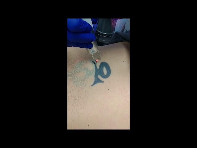 Back Laser Tattoo Removal at Skin Deep Laser Services Burke VA