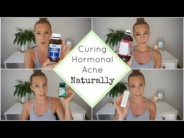 Hormonal Acne Update | PCOS | How I Cured My Acne