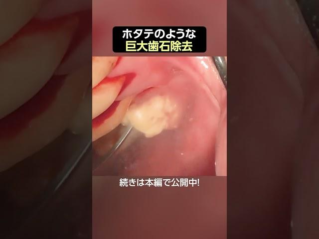 【歯石除去】ホタテのような巨大歯石 #歯医者 #歯石除去 #dentist #ザホワイトデンタルクリニック