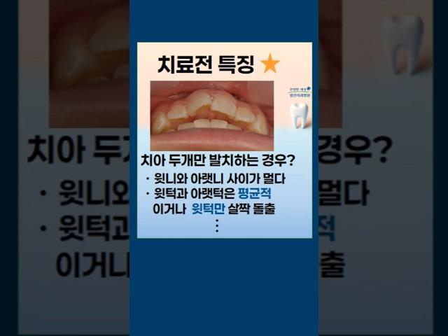 치아 2개만  빼고 교정치료하는 경우는? #발치교정 #상악소구치발치