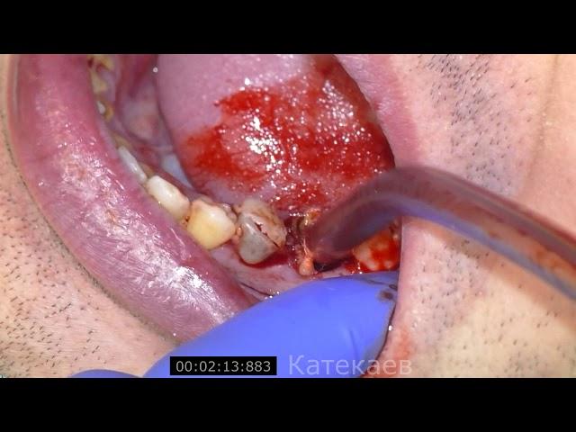 tooth extraction