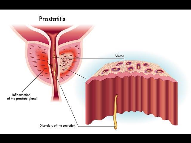 Wise Anderson Protocol- Prostatitis: Clearing Up the Confussion Part A