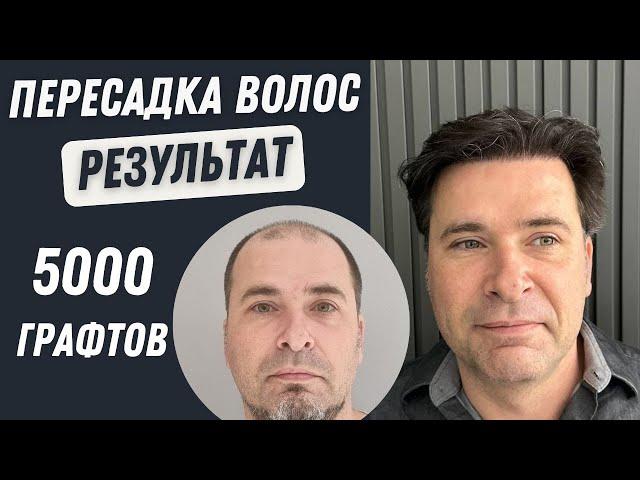 Пересадка Волос в Турции До и После 5000 графтов | Пересадка волос в Турции