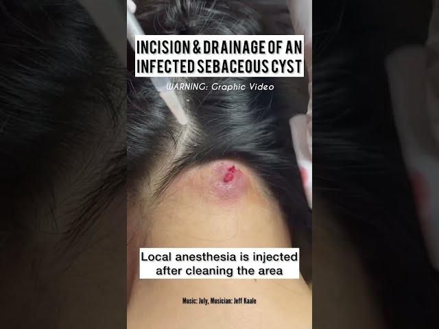 Incision and Drainage of a Sebaceous vs Epidermoid Cyst #shorts