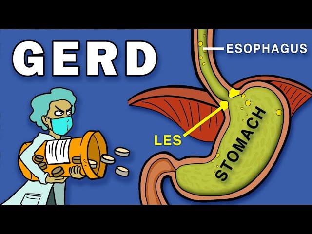 Gastroesophageal Reflux Disease (GERD)