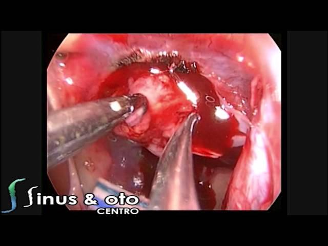 Endoscopic Pituitary Surgery