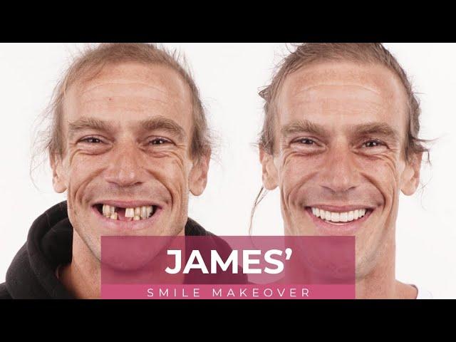 James' Dental Implants Smile Makeover Journey at Dental Boutique