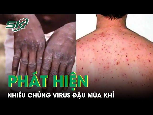 Chủng Virus Đậu Mùa Khỉ Ở Ấn Độ Không Giống Ở Châu Âu | SKĐS