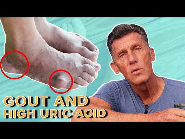 Keto and Carnivore's Biggest Fear: Gout and High Uric Acid