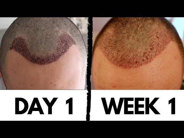 Hair Transplant Results after 1 Week! + How to Remove Scabs and Dry Skin of Implanted Area (DHI)