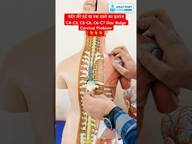 गर्दन के दर्द या नस दबने का इलाज | C4-C5, C5-C6, C6-C7 Disc Bulge / Cervical Problem #shorts #viral