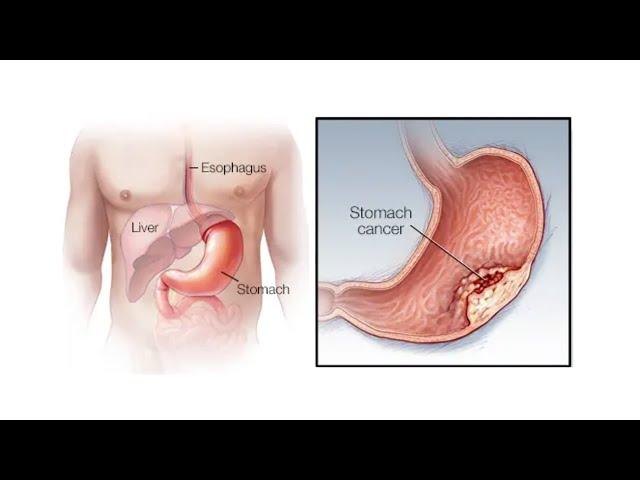 Mayo Clinic Minute: Stomach cancer concerns