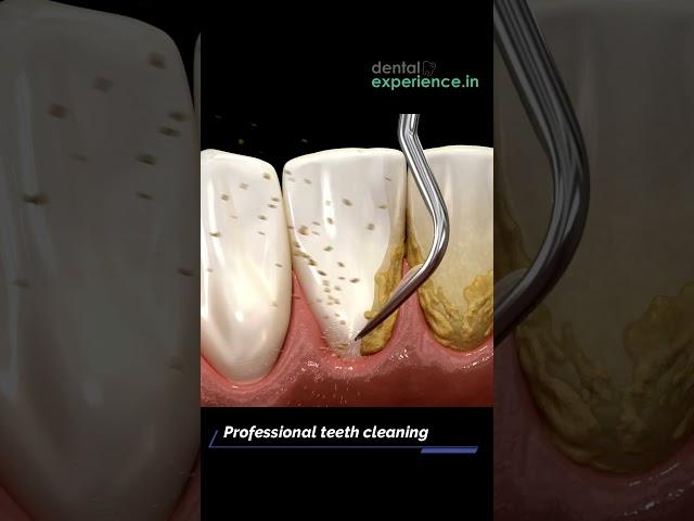 Tooth Cleaning | Teeth Scaling I stain or Tartar Removal cost | Dentalexperience.in