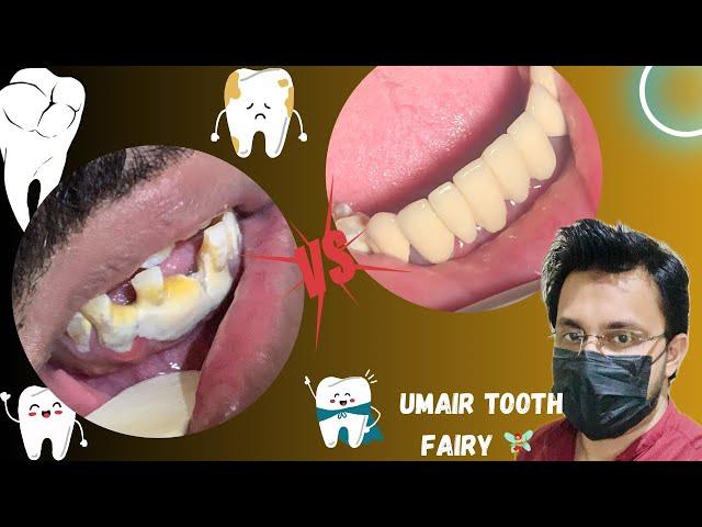 Smile makeover with lower anterior restoration #dental #dentistry #umairtoothfairy @Umairazeem8553