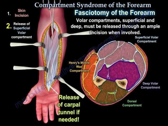 Compartment Syndrome Of The Forearm - Everything You Need To Know - Dr. Nabil Ebraheim