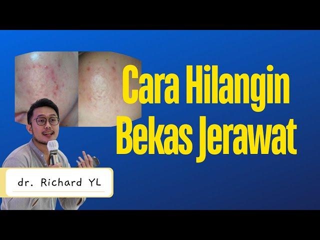 Cara menghilangkan Bekas Jerawat | Dokter Richard YL