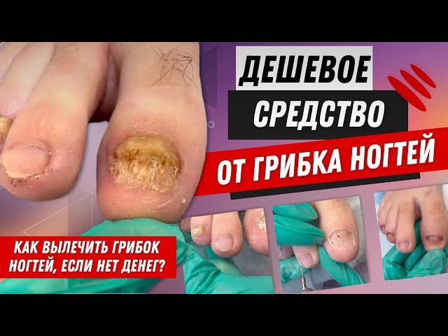 Дешевое средство от грибка ногтей/ Как вылечить грибок ногтей, если нет денег? #ногти #грибокногтей