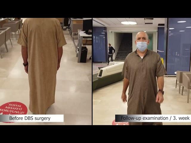 Change of Parkinson Patient Musabah Al SUQRI with DBS Treatment | Doç. Dr. Ali ZIRH