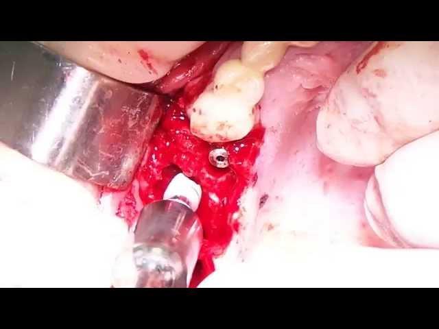 16 may 2014. Ilya Makaryevskiy + Implay Implants. Immed. Imp. Part 1