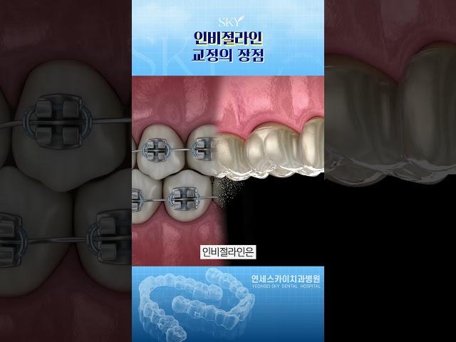 일반 교정보다 착용감이 좋은 인비절라인교정