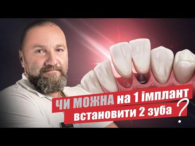  Чи можна на 1 імплант встановити 2 коронки?