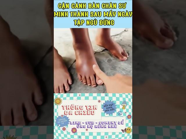THƯƠNG QUÁ: CHÂN CỦA CÁC VỊ SƯ SAU MẤY NGÀY NGỦ ĐỨNG? #suminhtue #thichminhtue  #thinhhanh #tintuc