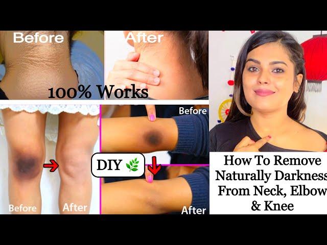 NECK WHITENING AT HOME IN 15 MINUTES || How to get rid From Dark Neck, Elbow & Knee Naturally ||