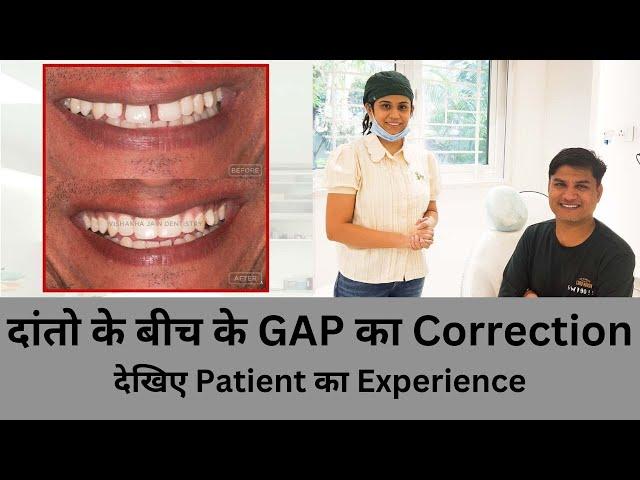 दांतो के बीच के GAP का Correction | Patient ka Experience | Seraphic Dental Indore | Dr Vishakha