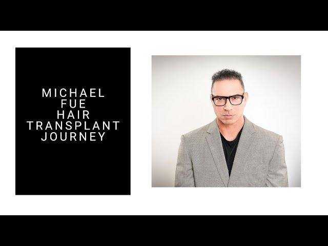 Michael FUE Hair Transplant Journey-Parsa Mohebi Hair Restoration